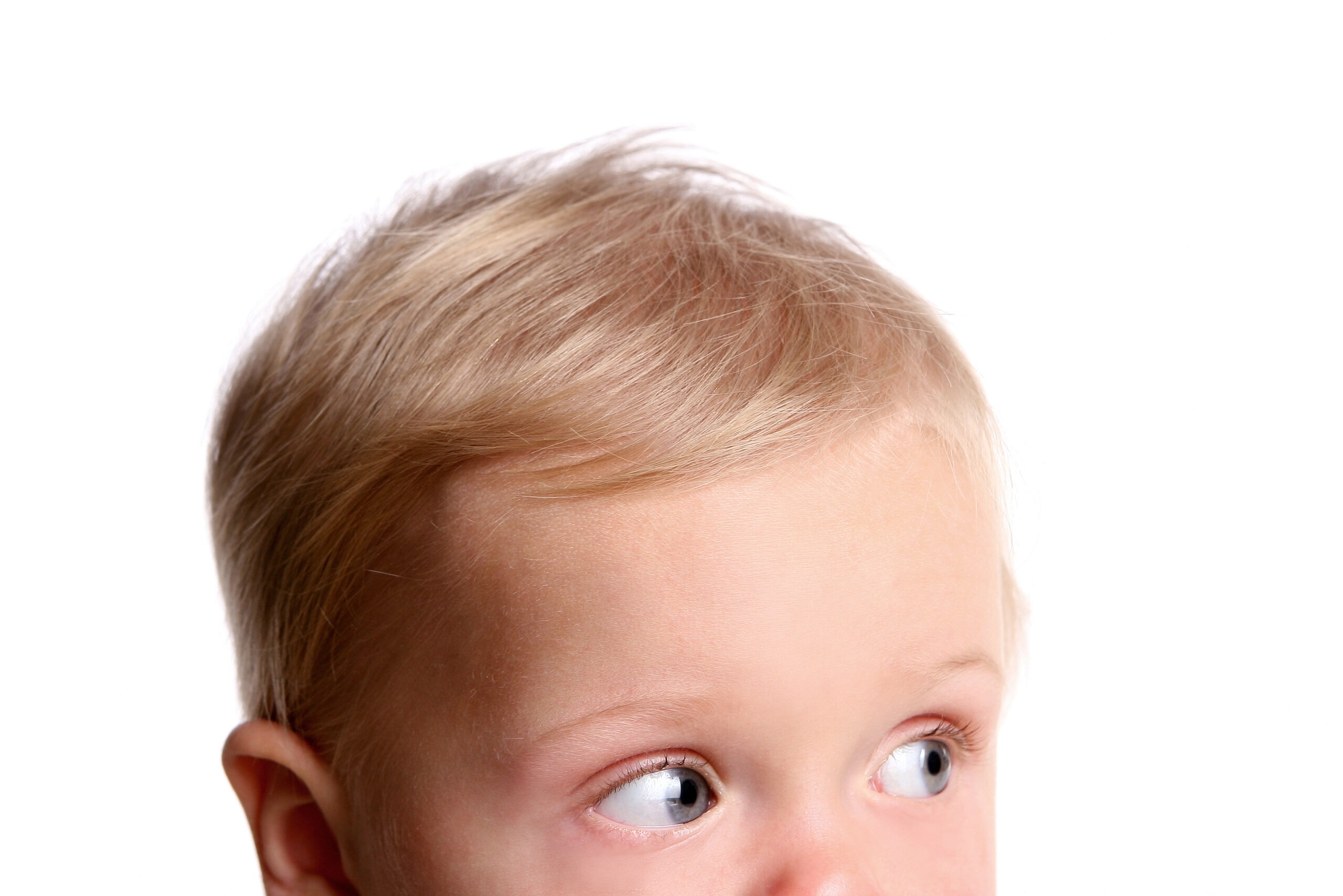 Plagiocefalia, czyli krzywa główka u niemowlaka, asymetria czaszki. Widoczna górna część głowy dziecka / niemowlaka. 